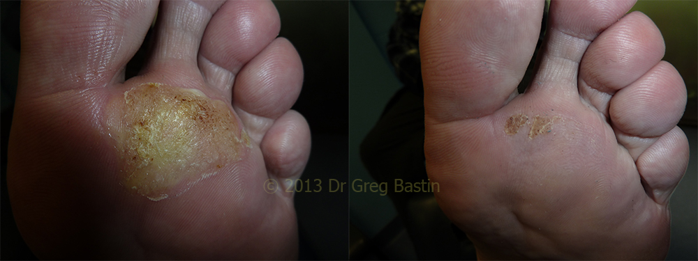 Wart Removal Specialist in Melbourne