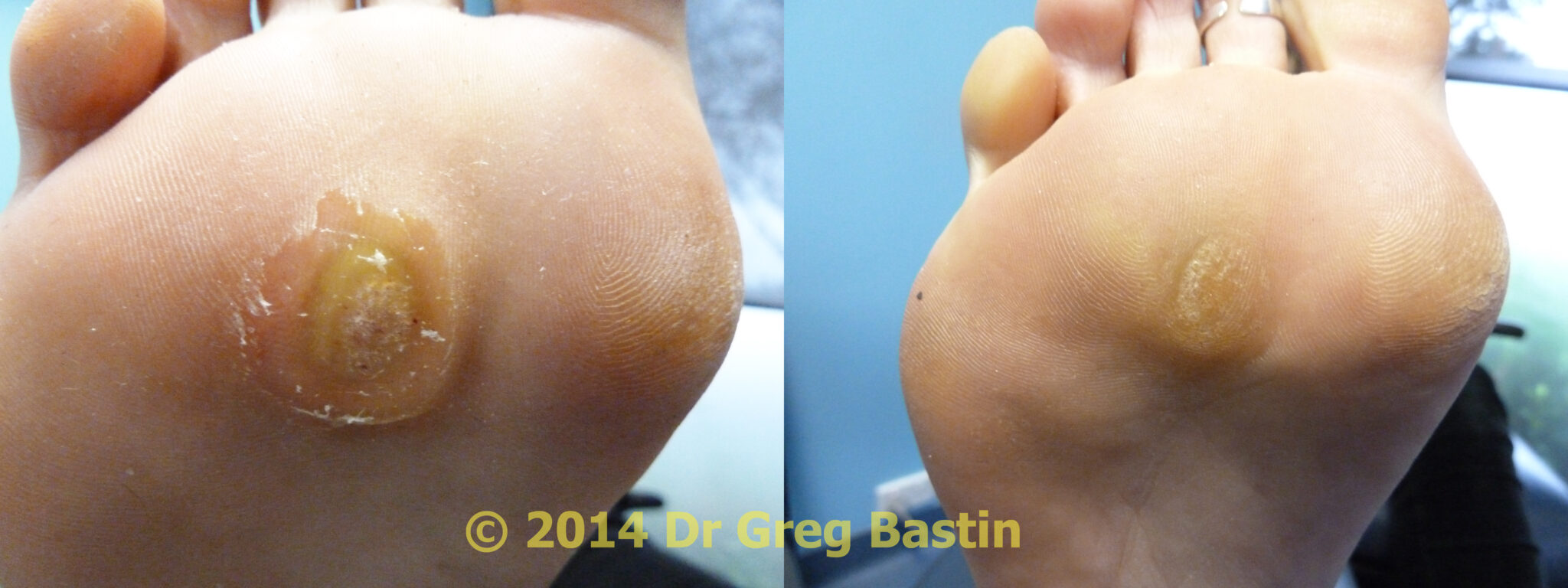 How to Remove Plantar Warts on Your Feet Laser Wart Treatment Wart