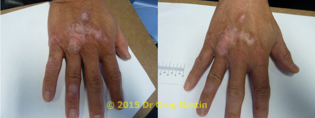 Hand Warts Removal