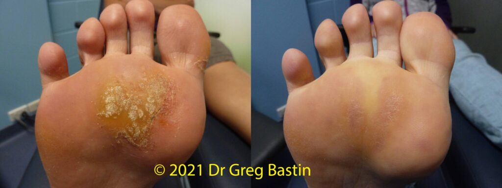 SWIFT Plantar Wart Treatment in Melbourne: Navigating the Landscape