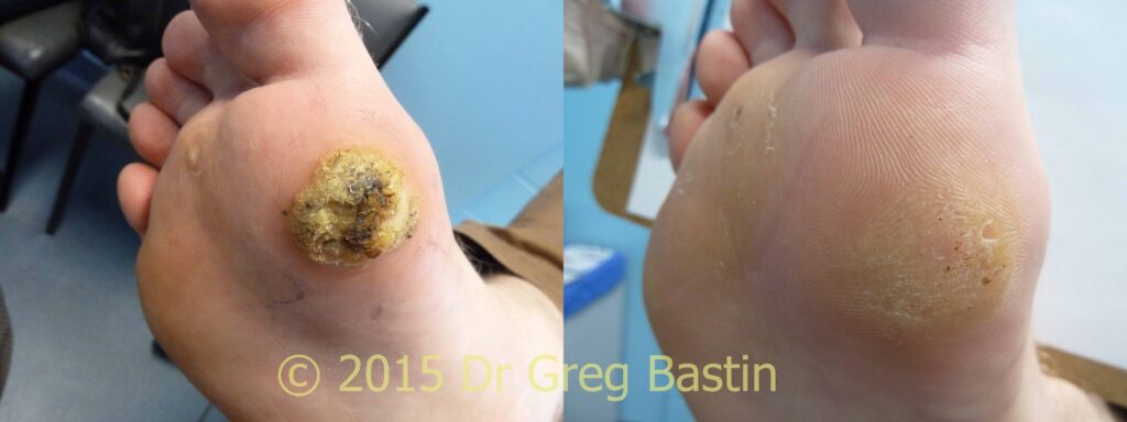 Laser Treatment for Plantar Warts in Australia