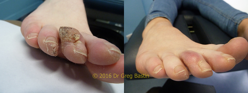 Wart Removal at Brighton Podiatry