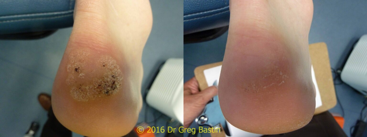 Laser Wart Removal Near Me