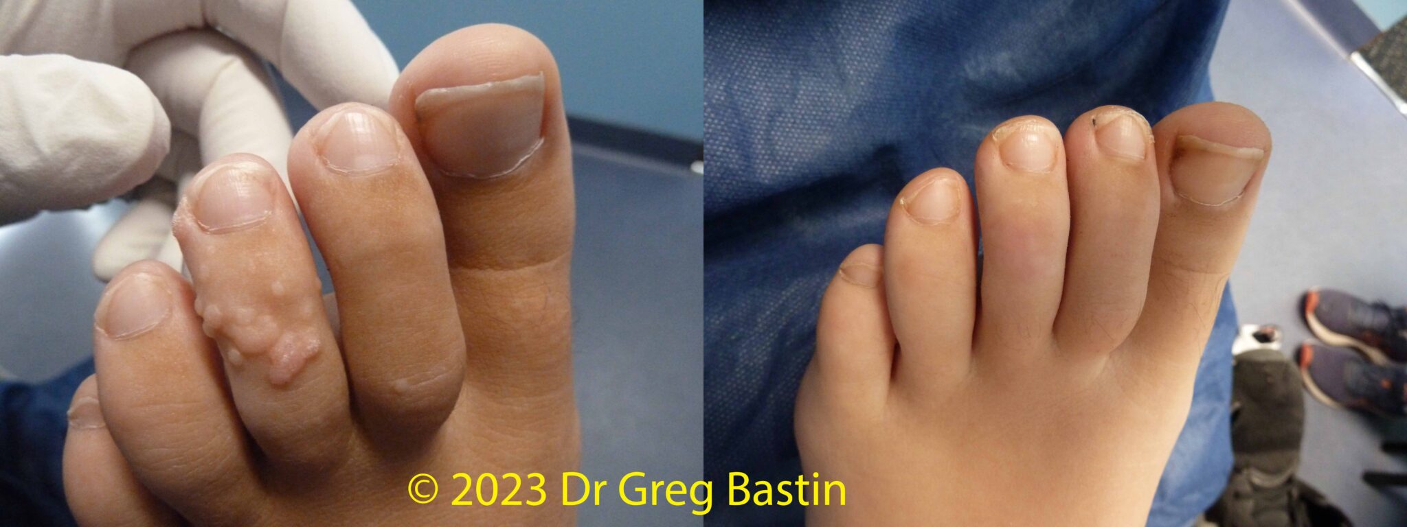 Wart Removal Melbourne 100 Success at Brighton Podiatry