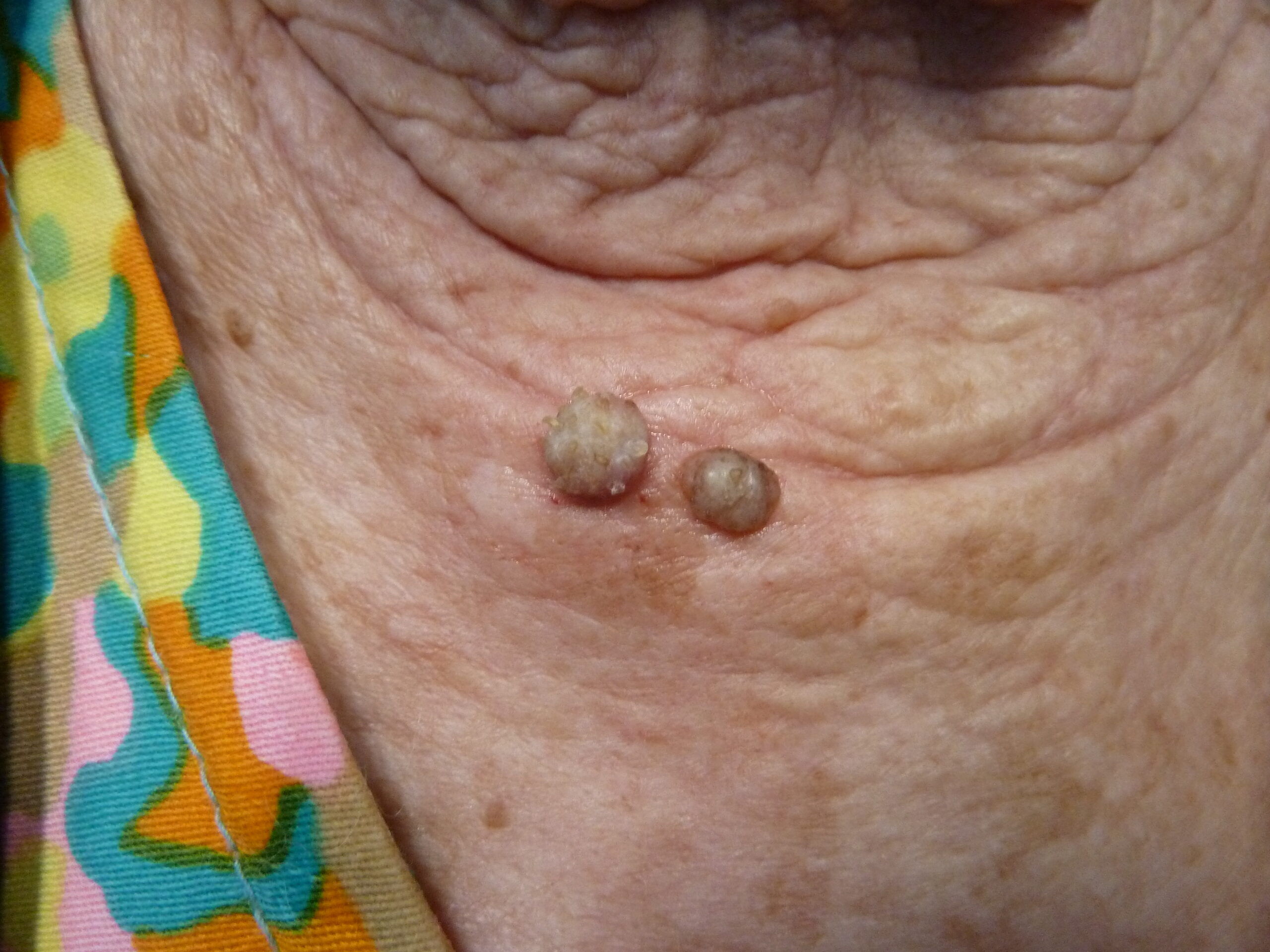 Age Warts Seborrhoeic Keratosis