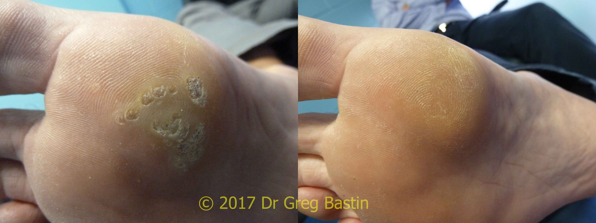 wart removal specialist treatment melbourne