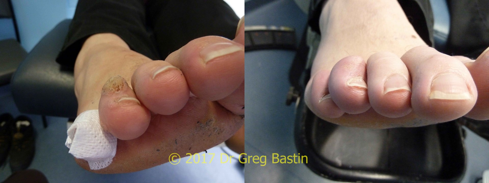 stubborn wart removal on feet