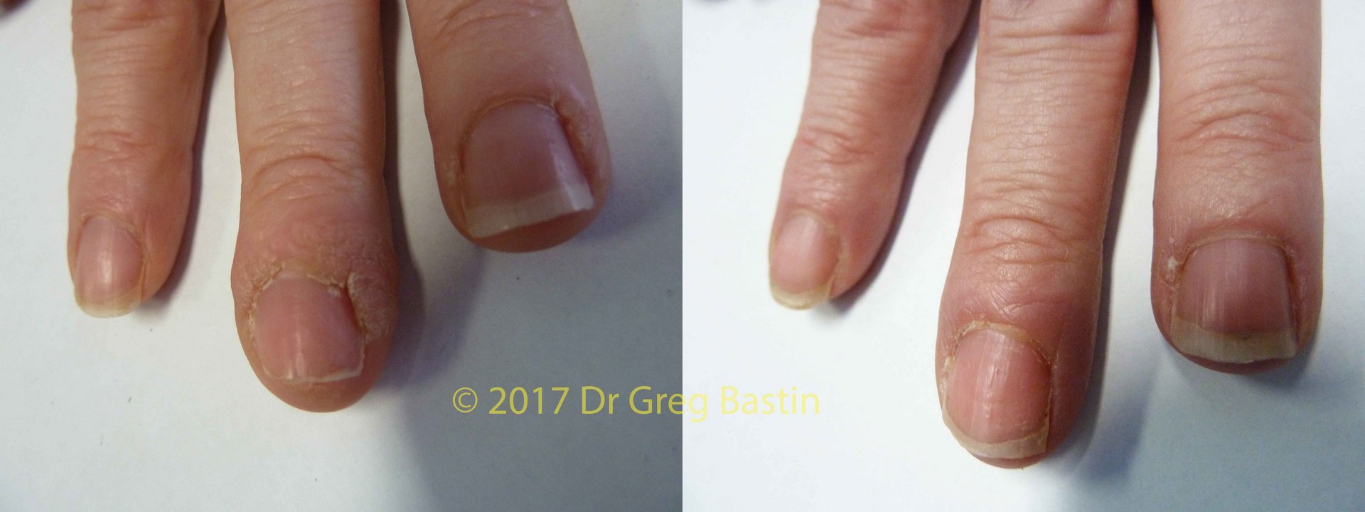 stubborn wart removal on hands