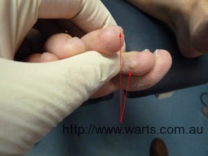 Plantar Warts Toes