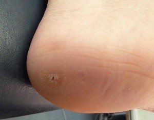 After Treatment Verruca Pedis (Plantar Wart)