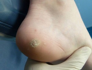 Before Treatment Verruca Pedis (Plantar Wart)